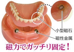 マグネットアタッチメント義歯